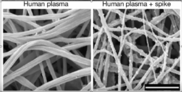 Warning: Global amyloidogenic health crisis confirmed